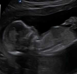 ZorgWonder.nl pretecho echo 2d 15 weken profiel