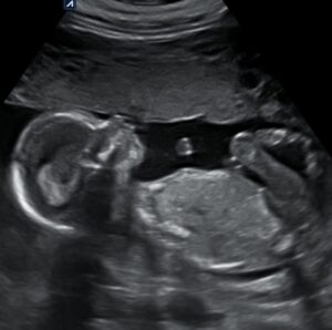 ZorgWonder.nl pretecho echo 2d totaal 15 weken profiel